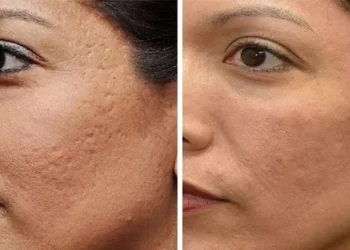 کاربرد میکرونیدلینگ و عوارض آن