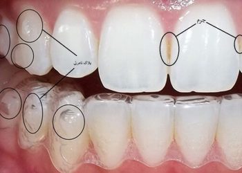 ارتودنسی نامرئی (اینویزیلاین)، بهترین روش زیبایی دندان برای بزرگسالان