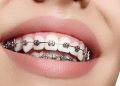 ارتودنسی دیمون، جدیدترین روش ارتودنسی ثابت دندان