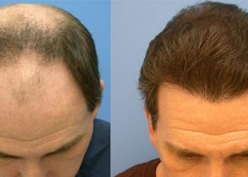 فواید مزوتراپی مو