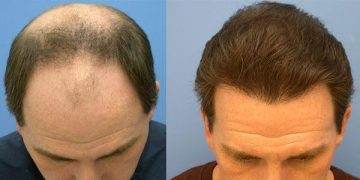 فواید مزوتراپی مو