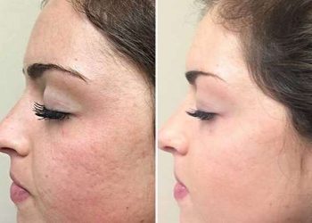 میکرونیدلینگ چیست؟ کاربرد میکرونیدلینگ و عوارض آن