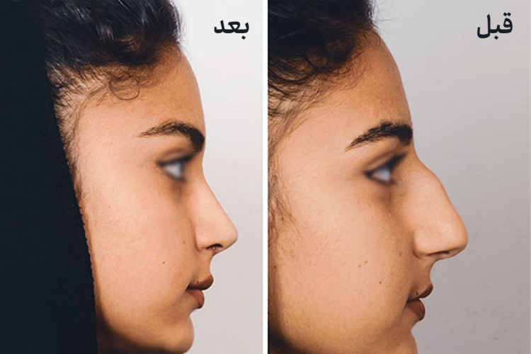 هزینه جراحی بینی استخوانی چقدر است؟