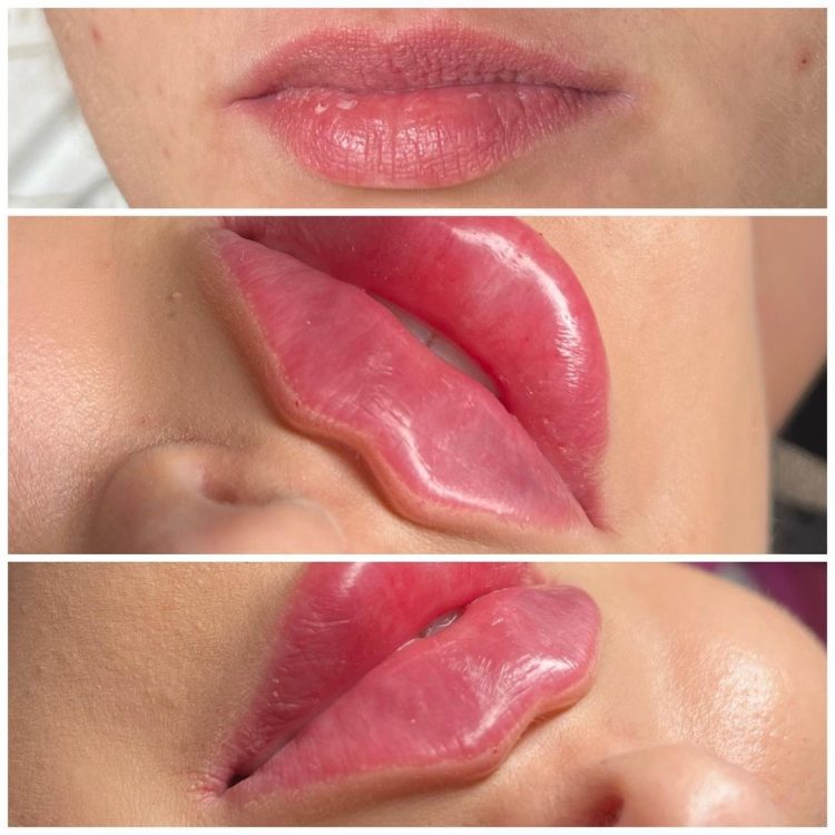 بهترین دکتر تزریق ژل لب