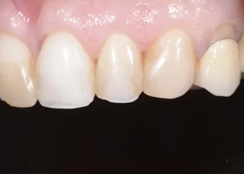کامپوزیت دندان؛ حفظ سفیدی و درخشندگی