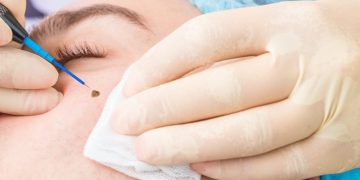 برداشتن خال