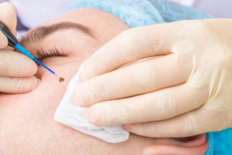 برداشتن خال