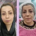 بهترین دکتر تزریق چربی در چیتگر
