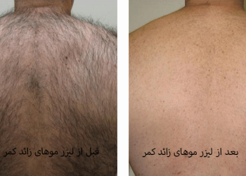 بهترین کلینیک لیزر موهای زائد آقایان در تهرانسر